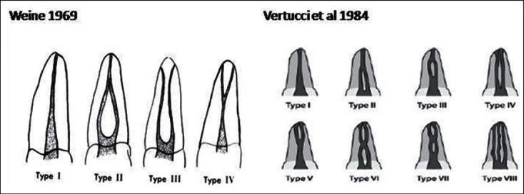 Root-canal-configuration-as-described-by