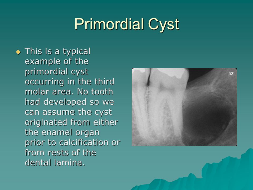 Primordial+Cyst.jpg#s-960,720