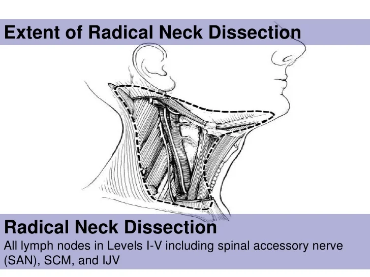neck-dissection-24-728.jpg?cb=1313384938#s-728,546