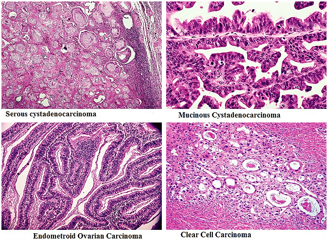ovarian_cancer_histology_x670.jpg