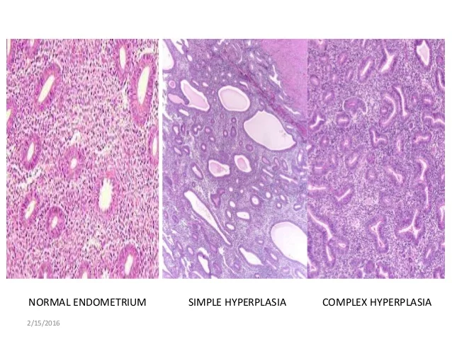 endometrial-hyperplasia-9-638.jpg?cb=1455525749#s-638,479