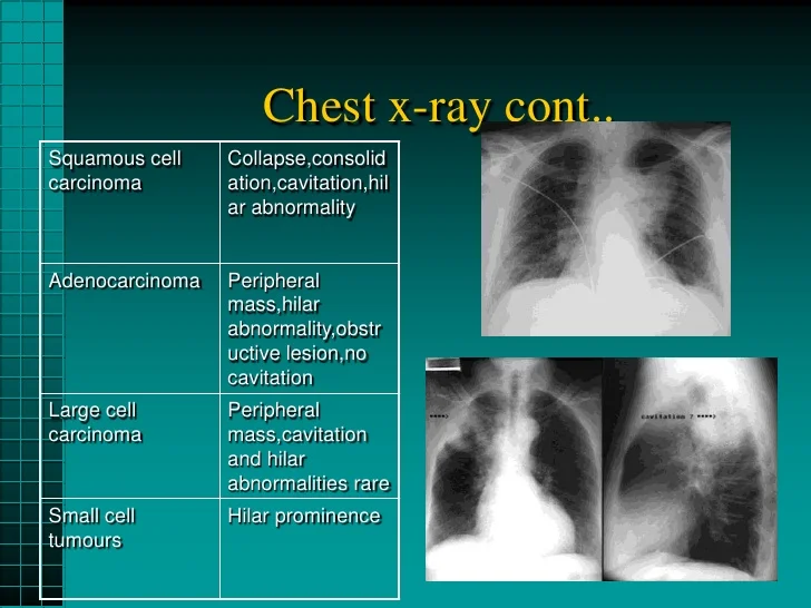 carcinoma-lung-21-728.jpg?cb=1338716083#s-728,546