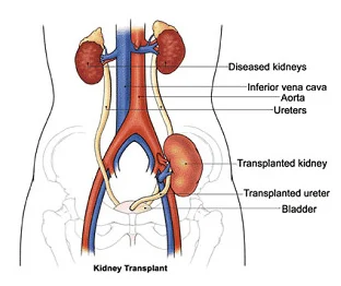 kidney-transplant-500x500.png#s-312,262
