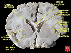 250px-Basal_ganglia_1.jpg#s-250,188