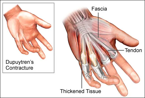 nucleus_rm_illustration_of_dupuytrens_contracture.jpg#s-493,335