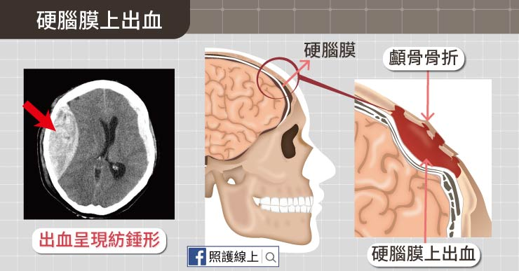 %25E9%25A1%25B1%25E5%2585%25A7%25E5%2587%25BA%25E8%25A1%2580-03.jpg#s-740,387