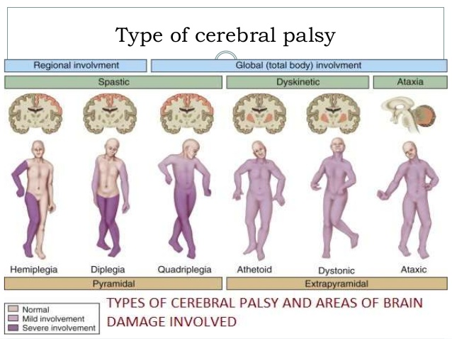 cereberal_palsy-original.jpeg#s-638,479