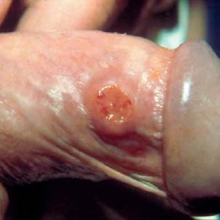 Donovanosis-ulcerated-lesion-of-the-hypertrophic-borders-of-the-penis_Q320.jpg