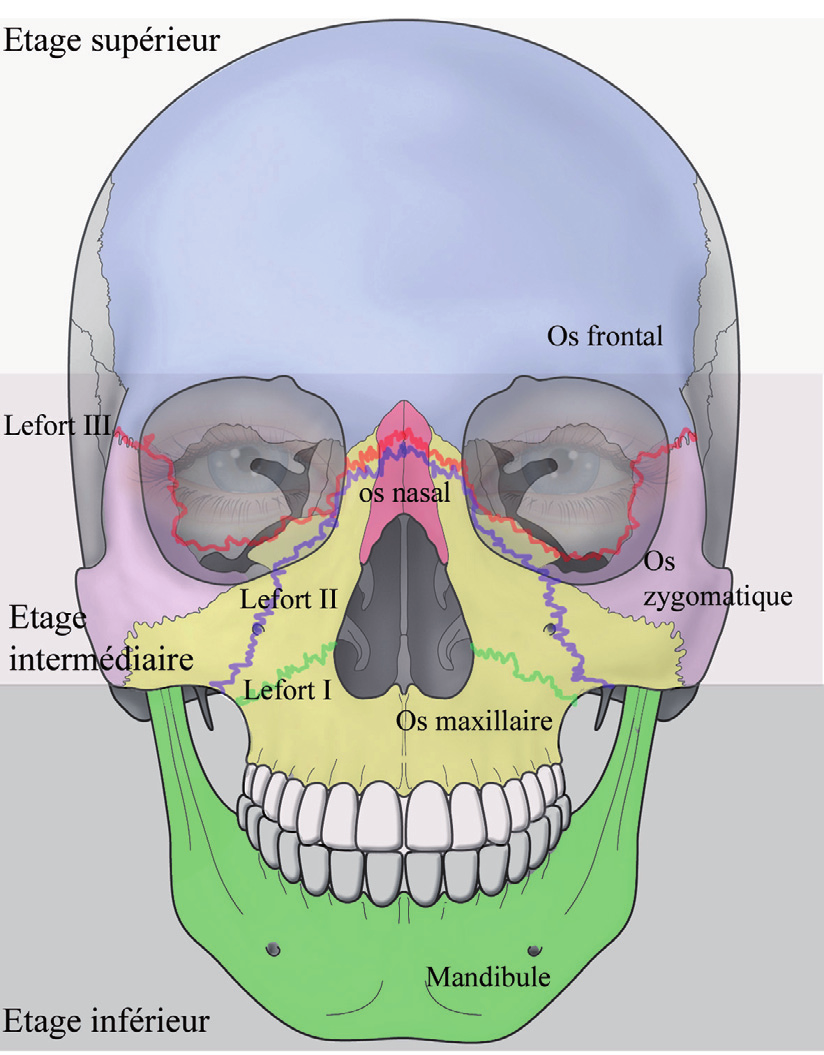 Representation-schematique-des-etages-faciaux-et-des-fractures-de-Lefort.png
