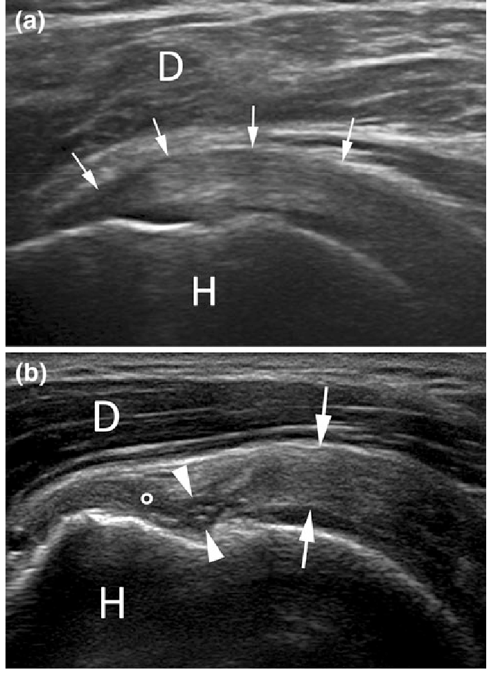 Ultrasound-of-the-shoulder-a-Normal-appearance-of-supraspinatus-tendon-arrows-showing.png