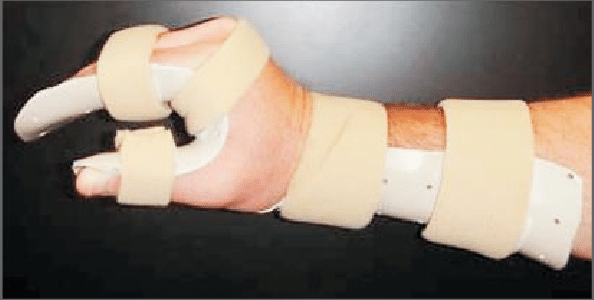 Position-of-Hand-for-Splinting-Burns-and-Frostbites-of-the-Hand.png