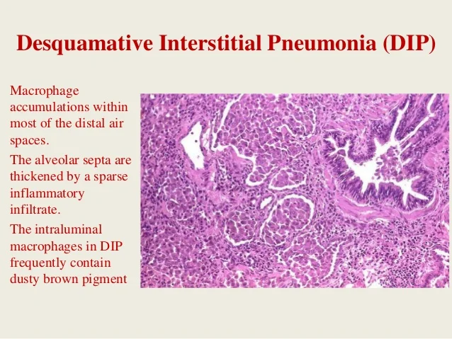 smoking-related-interstitial-lung-diseases-56-638.jpg?cb=1429455492
