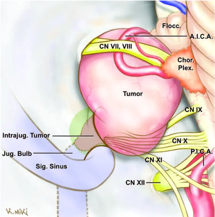 Suprajugular-extension-retrosigmoid-approach.jpg?ssl=1