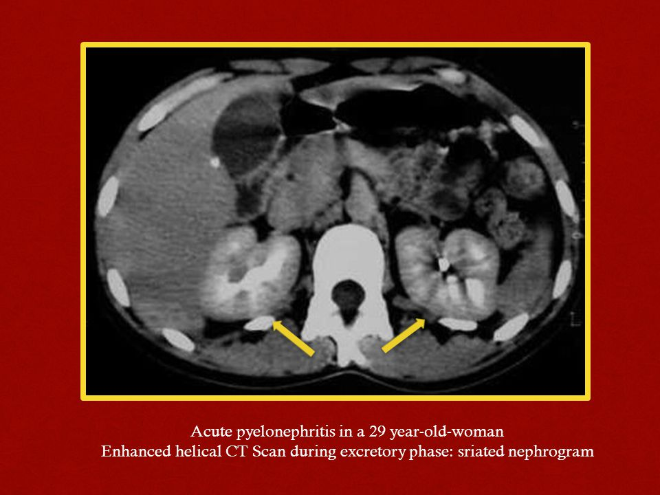Acute+pyelonephritis+in+a+29+year-old-woman.jpg