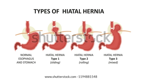 types-hiatal-hernia-600w-1194881548.jpg