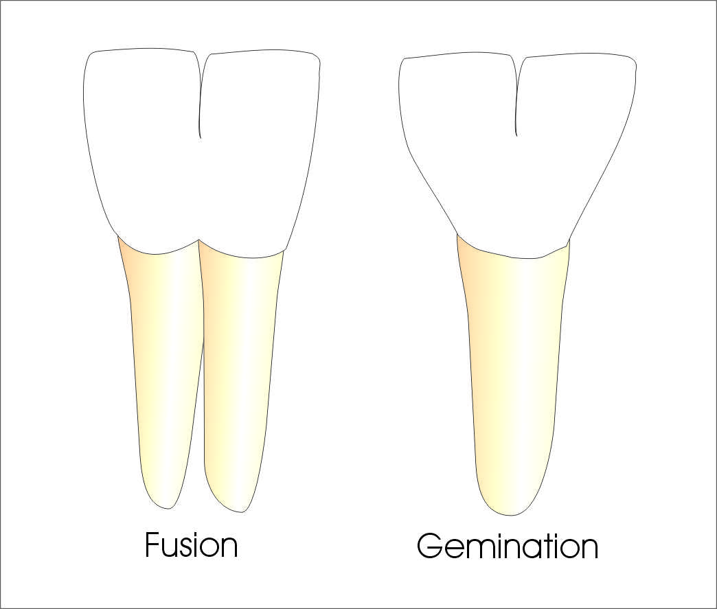 Tooth-Fusion-Gemination.jpg