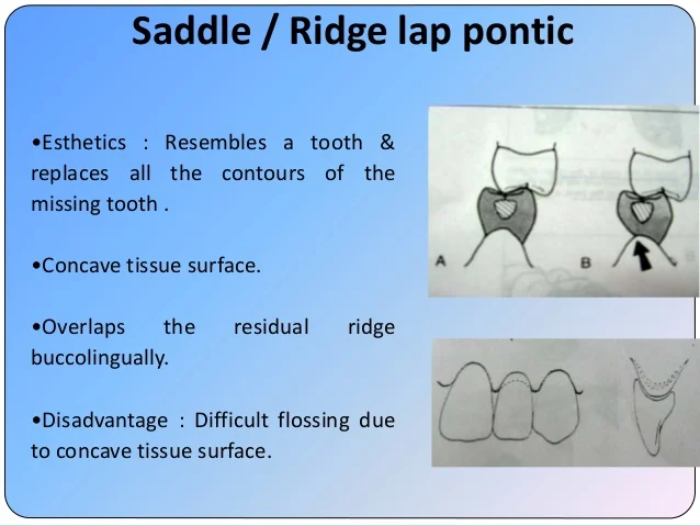 esthetics-in-fpd-42-638.jpg?cb=1526308299