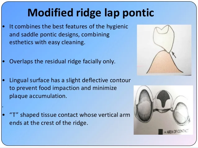 esthetics-in-fpd-43-638.jpg?cb=1526308299