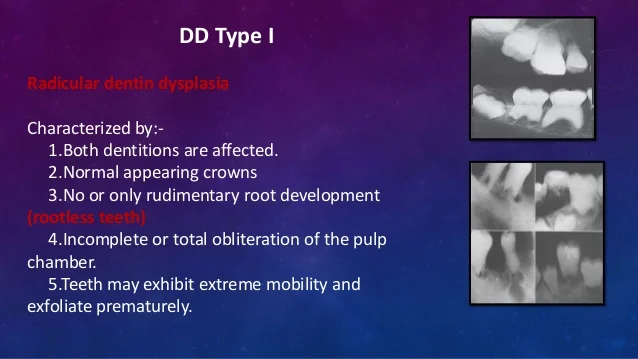 dentin-dysplasia-3-638.jpg?cb=1529517181