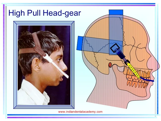 headgears-24-638.jpg?cb=1506320739