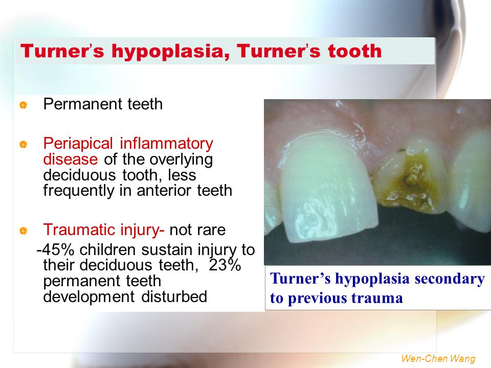 Turner%E2%80%99s+hypoplasia%2C+Turner%E2%80%99s+tooth.jpg