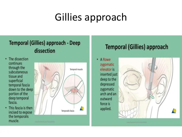 sir-harold-delf-gillies-father-of-modern-plastic-surgery-17-638.jpg?cb=1529394082