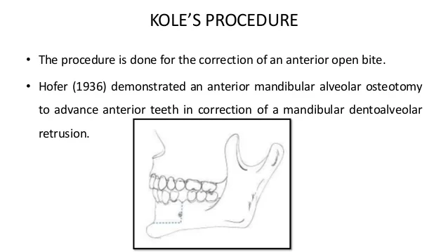 genioplasty-51-638.jpg?cb=1529070564