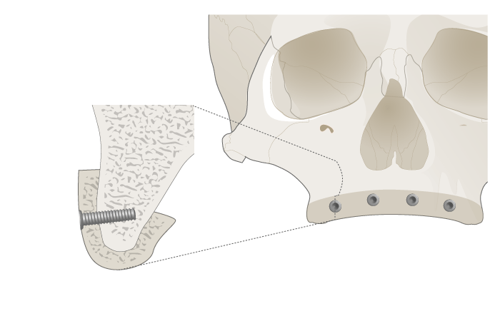 3067-grafting-upper-jaw-1.png?itok=4jw7qwFu
