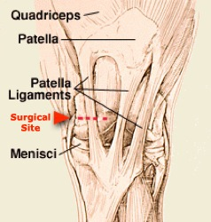 Medial%20patella%20ligament.jpg