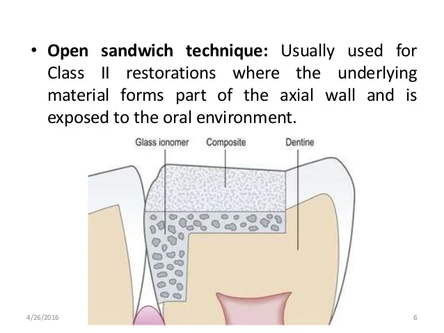 sandwich-technique-6-638.jpg?cb=1461696868