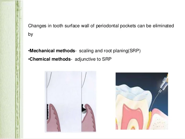 root-surface-treatment-in-periodontics-9-638.jpg?cb=1539778293