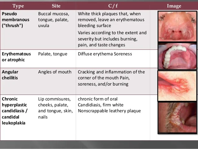 candidiasis-jc-11-638.jpg?cb=1408204293