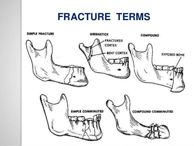 classification-of-mandible-fracture-3-638.jpg?cb=1485959127