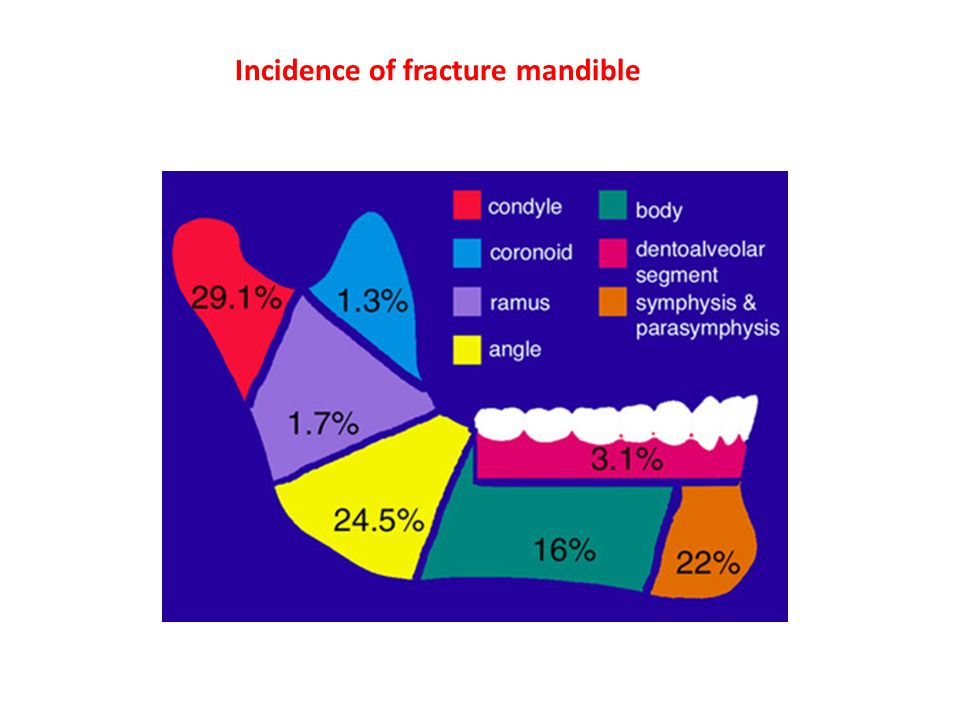 Incidence+of+fracture+mandible.jpg