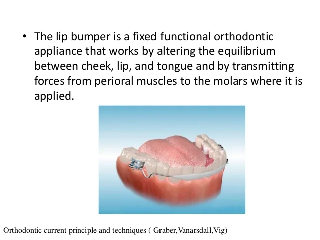 lip-bumper-quad-helix-tongue-cribtpanance-by-drsaurav-mishra-56-638.jpg?cb=1508070478
