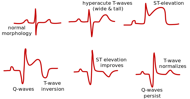 %25E5%25BF%2583%25E8%2582%258C%25E6%25A2%2597%25E5%25A1%259E%2BMyocardial%2Binfarction%252C%2BMI.png