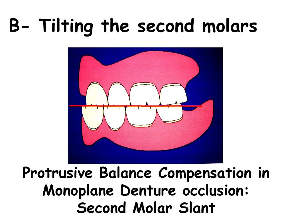 B-+Tilting+the+second+molars.jpg