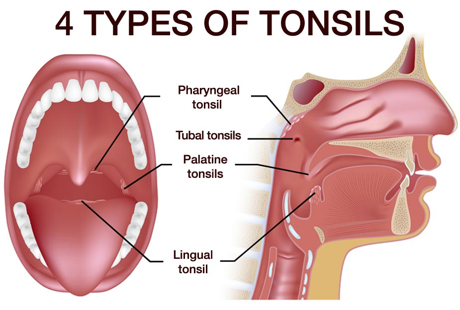 4-types-of-tonsils.jpg