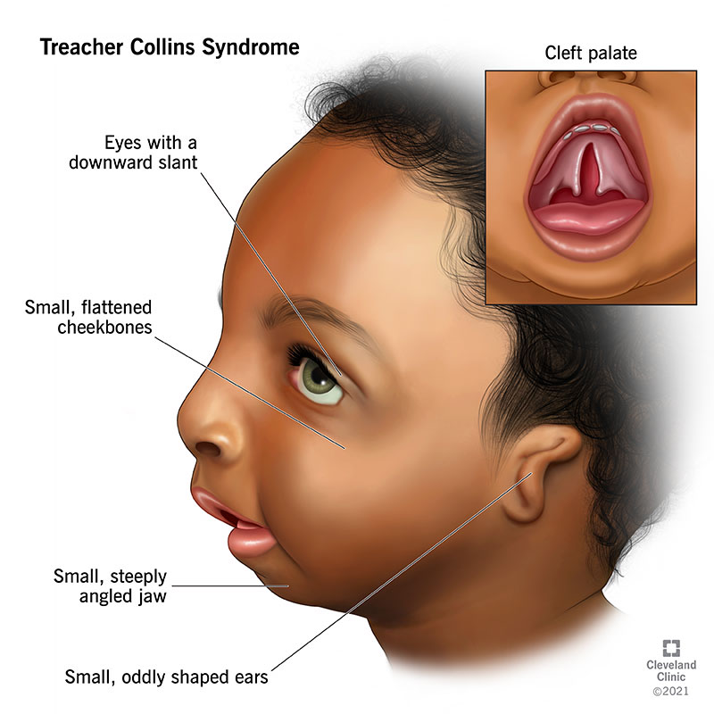 22149-treacher-collins-syndrome