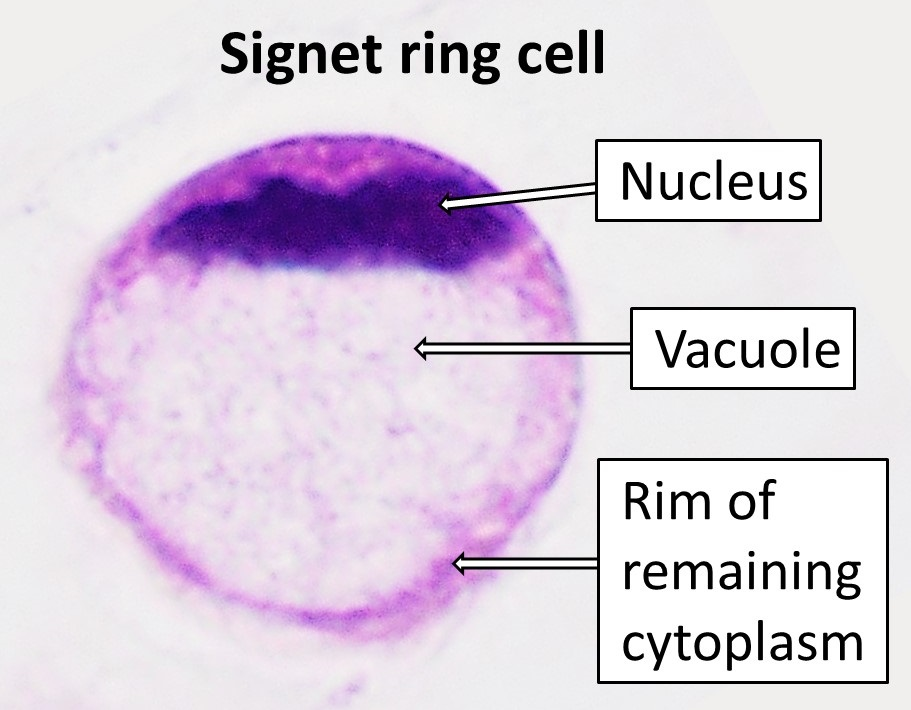 Signet_ring_cell.jpg