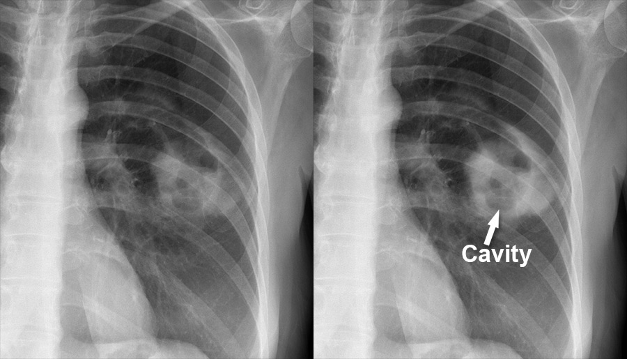 cavity_lung_abscess_2.jpg?mtime=20210304211317&focal=none