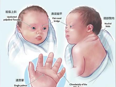 唐氏综合征是什么原因造成的-抖音