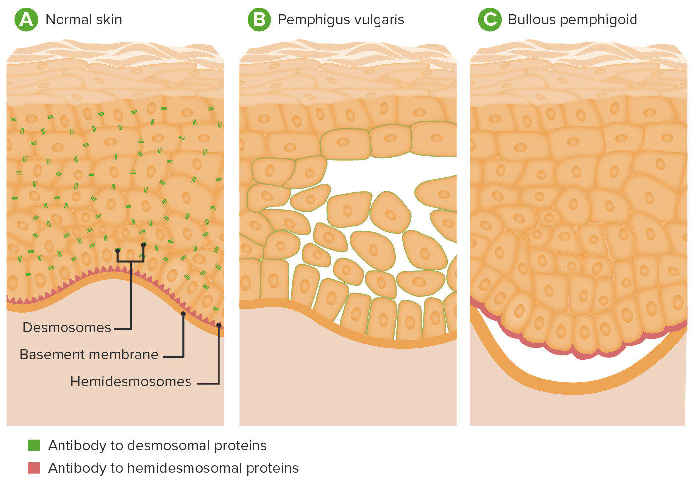 Pathophysiology-of-pemphigus-vulgaris-and-bullous-pemphigoid.jpg