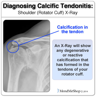xray-diagnosis-of-calcific-tendonitis.jpg