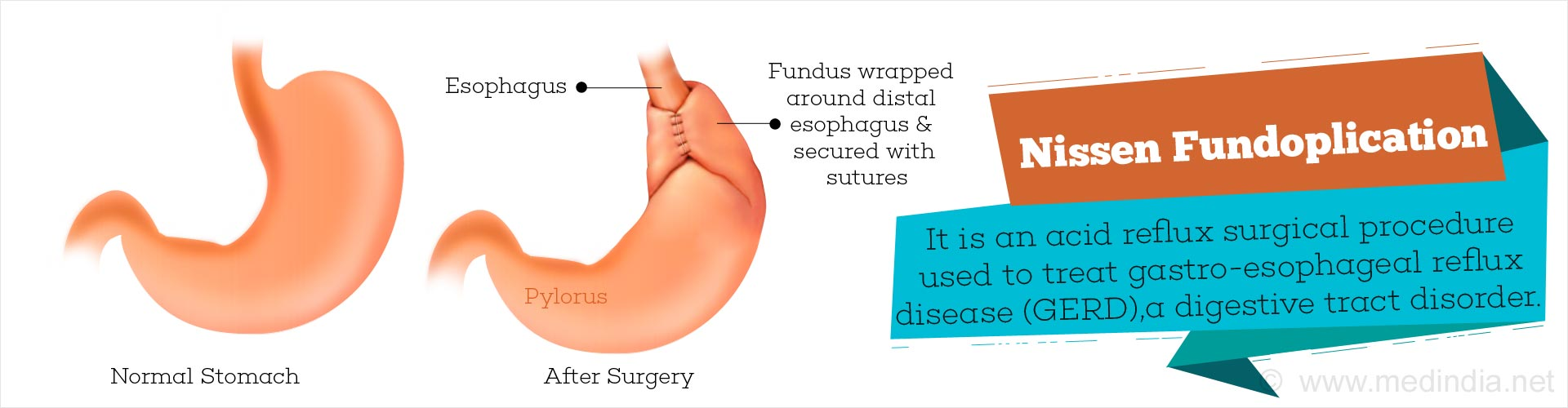 nissen-fundoplication.jpg
