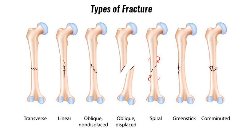 types-of-fracture800.jpg