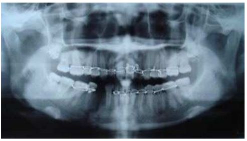 重新載圖16 一位病人兩個月前因為車禍導致右下顎骨骨折與右下第一小臼齒喪失 他接 阿摩線上測驗