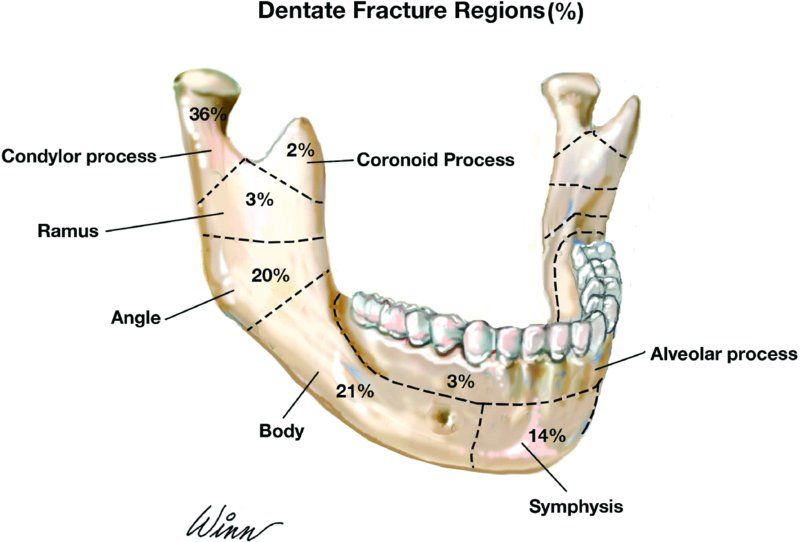 38 考量外力的衝擊及下顎骨的解剖特性 就下顎骨骨折分布區域 下列何者發生的機率 阿摩線上測驗