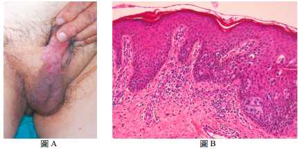 35 一位75 歲男性 在陰囊與陰莖處出現濕疹樣搔癢的紅色斑塊如圖a 皮膚 阿摩線上測驗