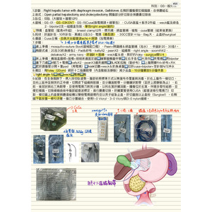 開腹部分肝切除合併膽囊切除術